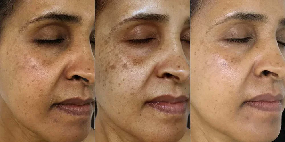 Suero Corrector de Manchas Oscuras con Vitamina C para Hiperpigmentación, Melasma y Marcas de Acné en Rostro y Manos - Image 5